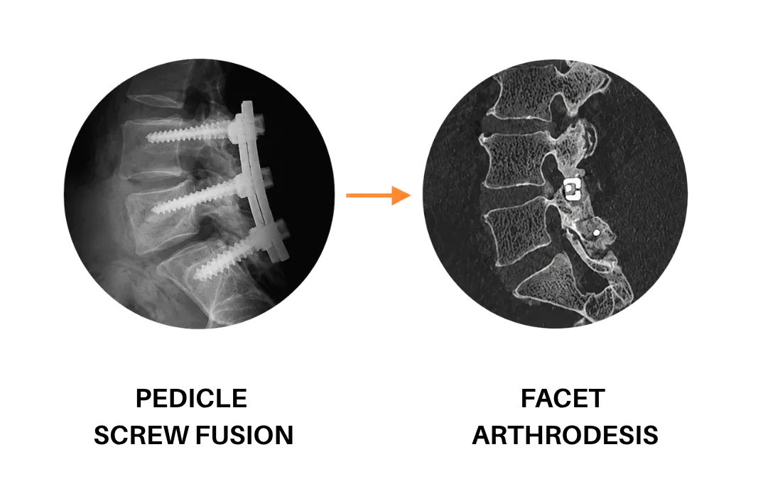 Comparison infographic between pedicle screws and FFX