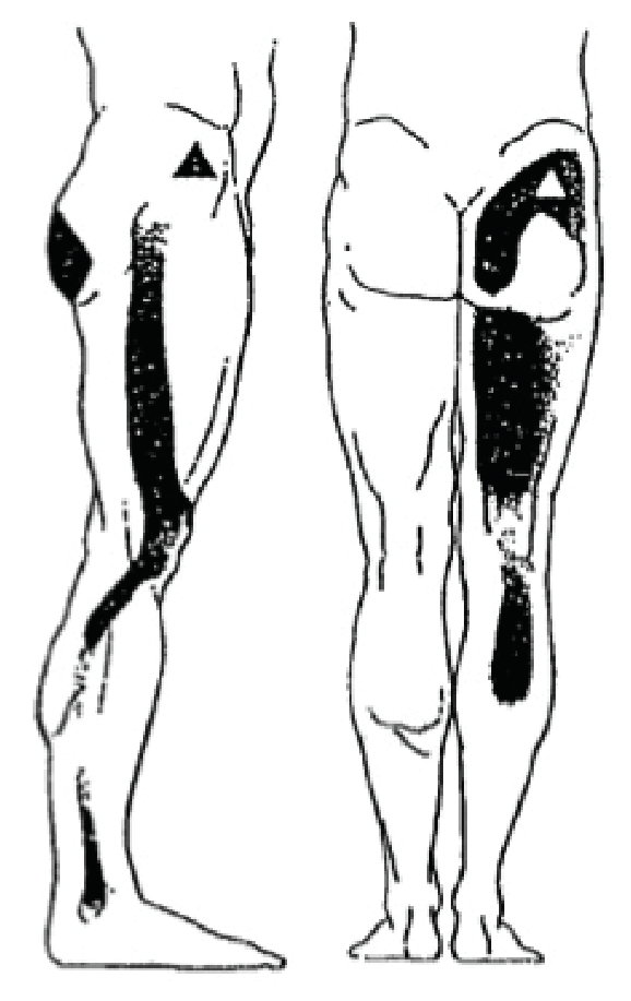Illustration du questionnaire DLF : Morcelées incomplètes situées à la face latérale ou postérieure : De la cuisse
