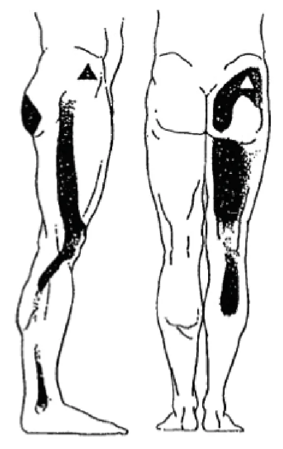 Illustration du questionnaire DLF : Morcelées incomplètes situées à la face latérale ou postérieure : De la cuisse