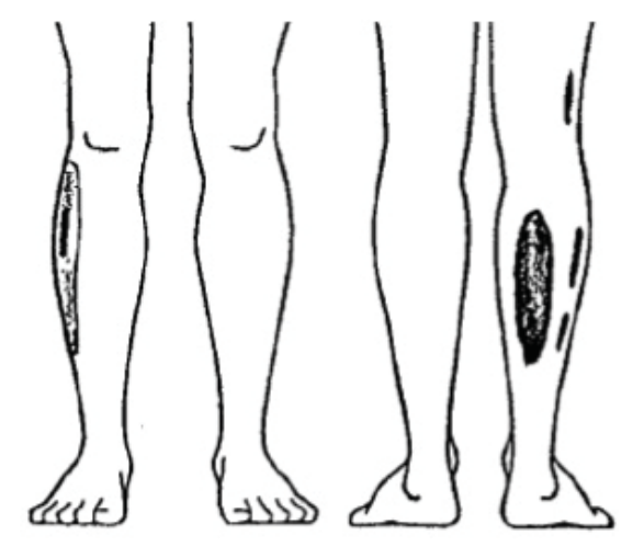 Illustration du questionnaire DLF : Morcelées incomplètes situées à la face latérale ou postérieure : De la jambe