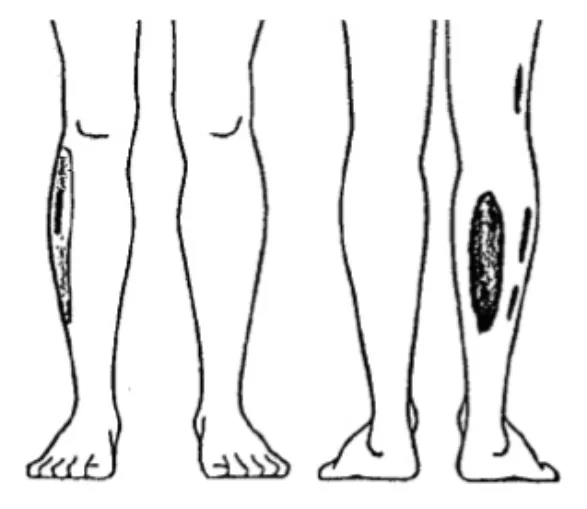 Illustration du questionnaire DLF : Morcelées incomplètes situées à la face latérale ou postérieure : De la jambe