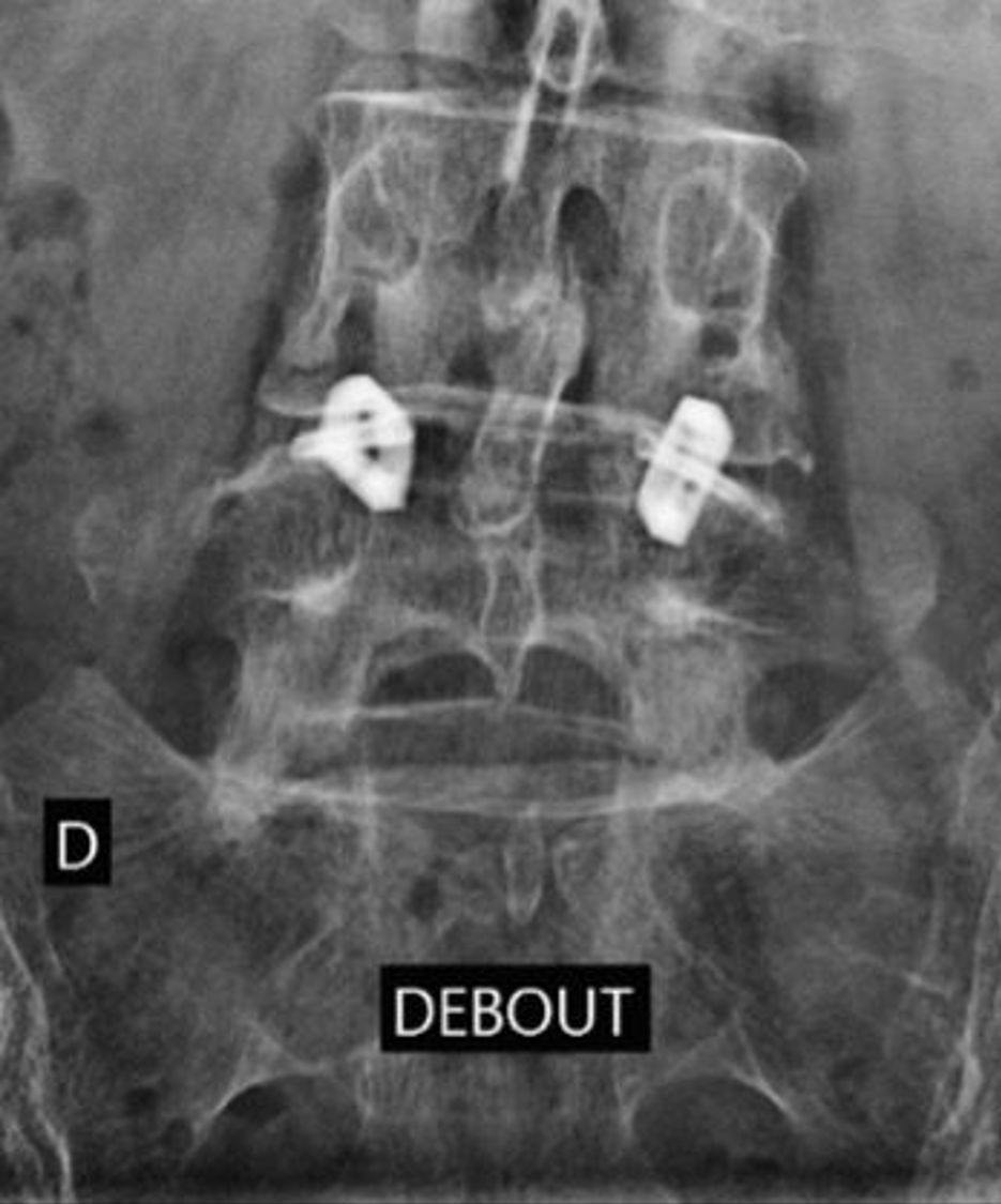 Radiographie lombaire illustrant le syndrome facettaire