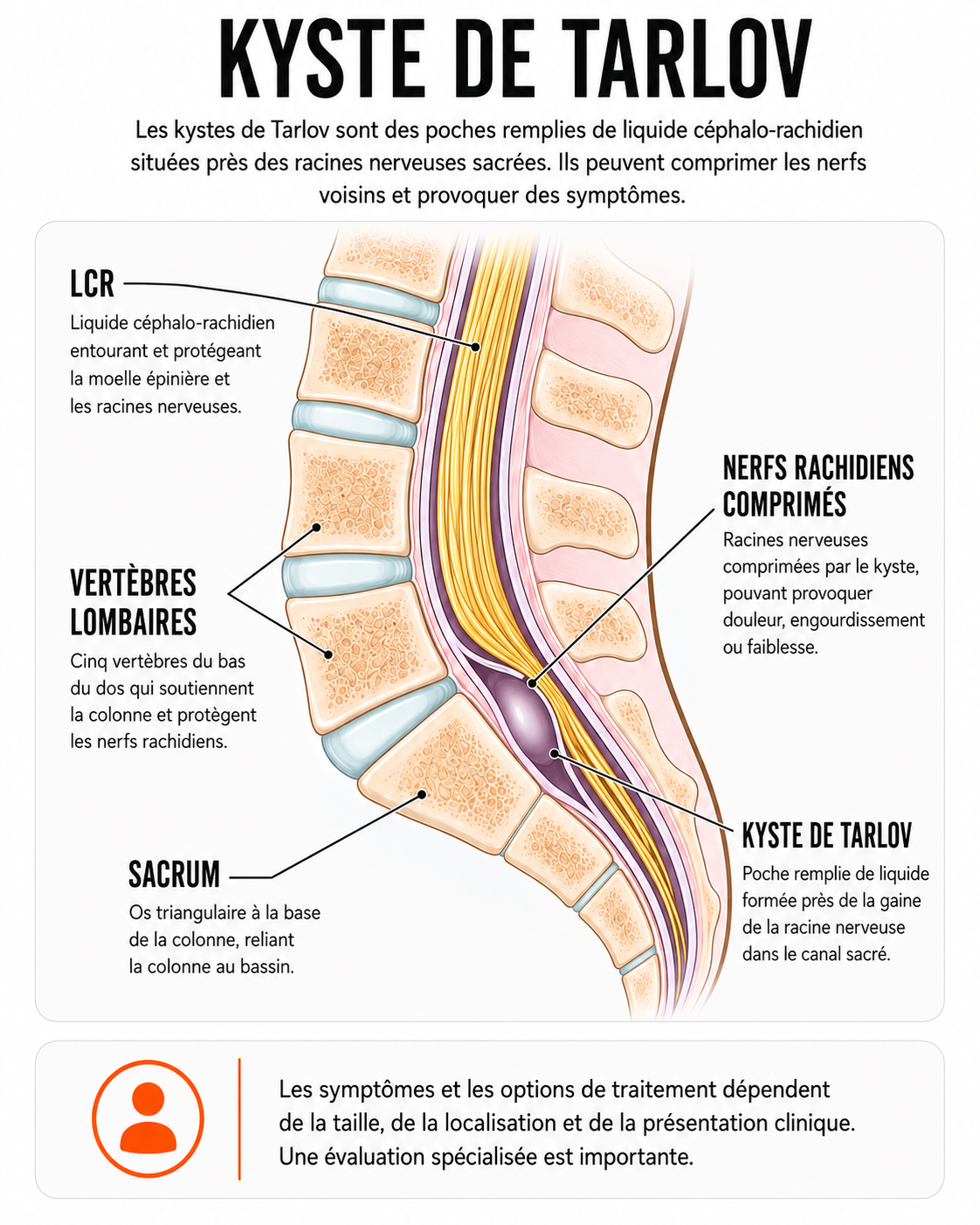Infographie anatomique du kyste de Tarlov