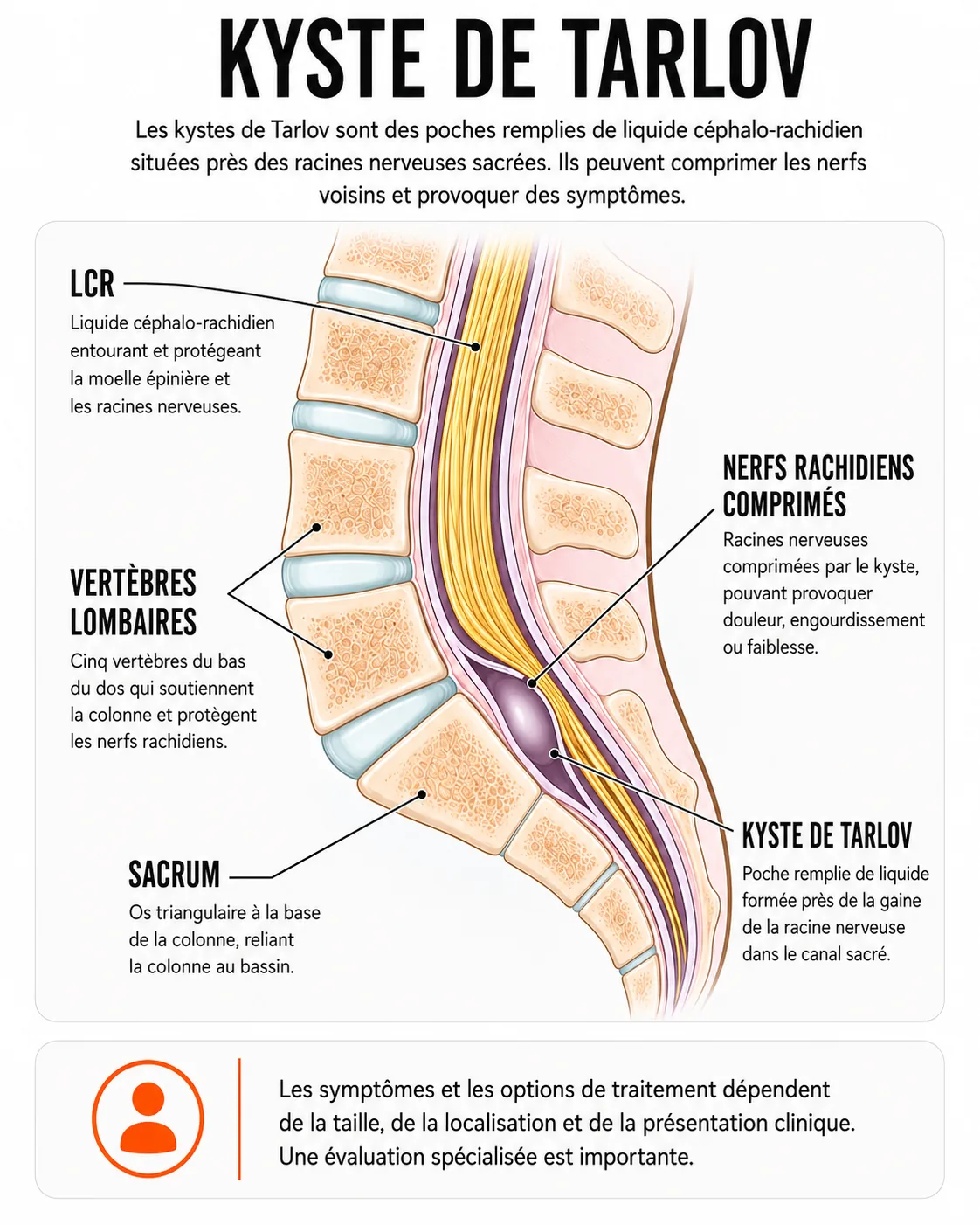 Infographie anatomique du kyste de Tarlov