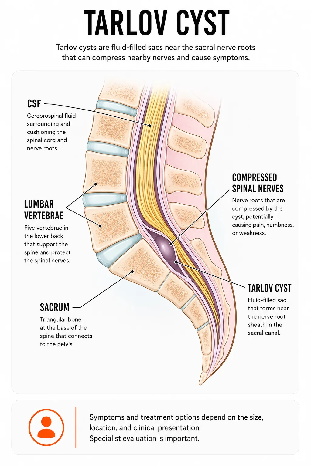 Tarlov cyst anatomy infographic
